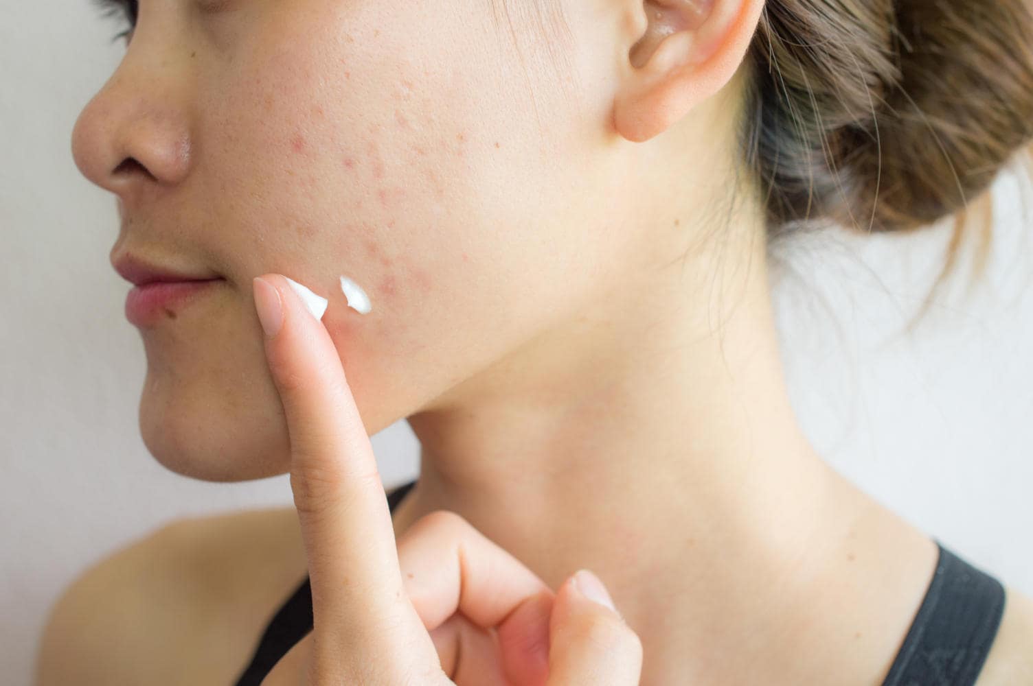 Adolescente che applica della crema sull'acne