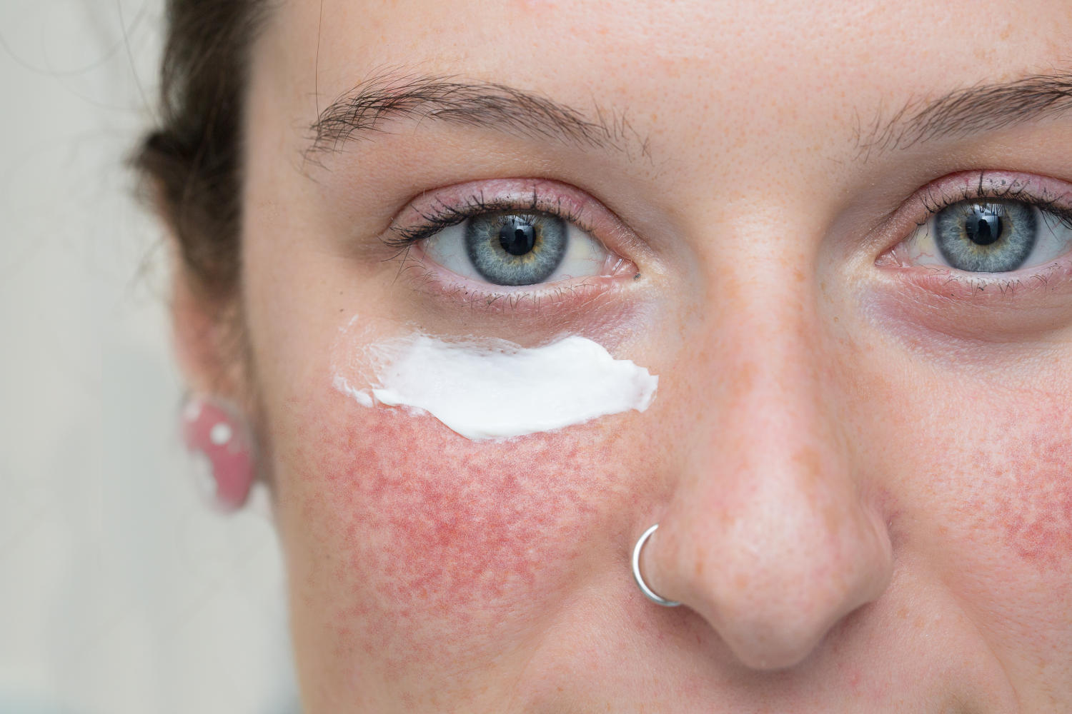 Ragazza affetta da rosacea che ha applicato della crema sotto gli occhi