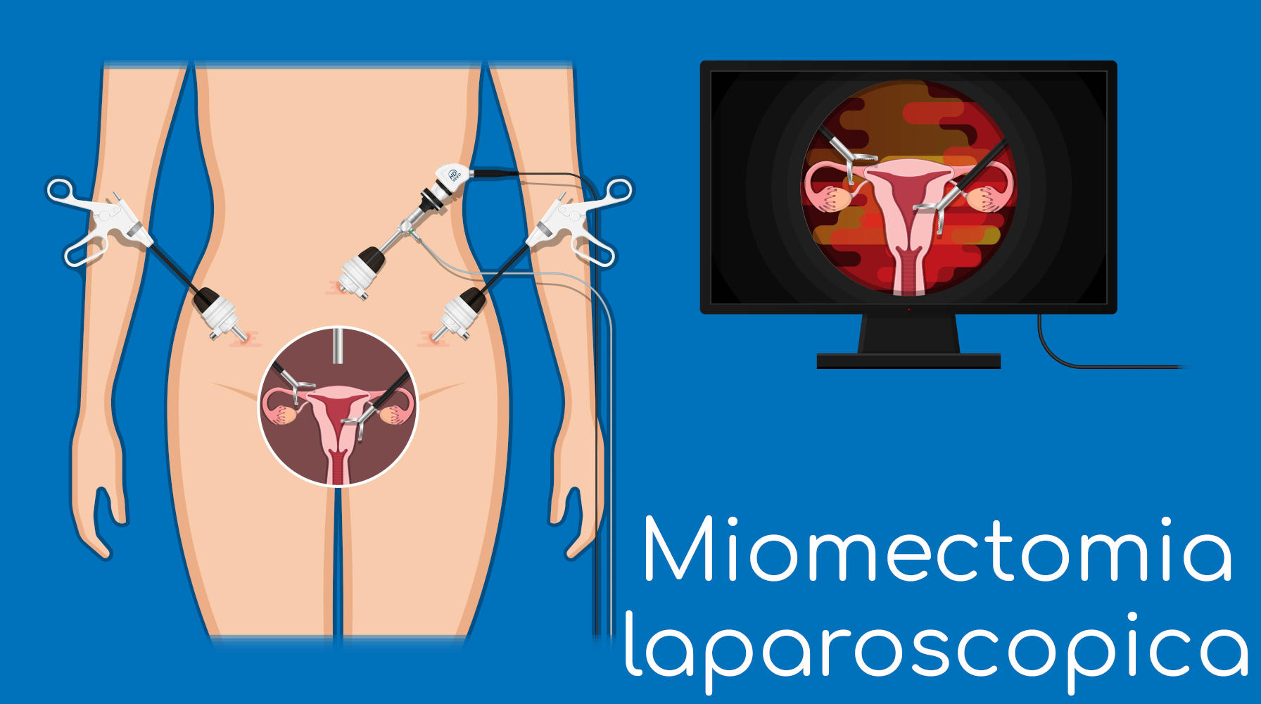 Grafica concettuale della miomectomia laparoscopica