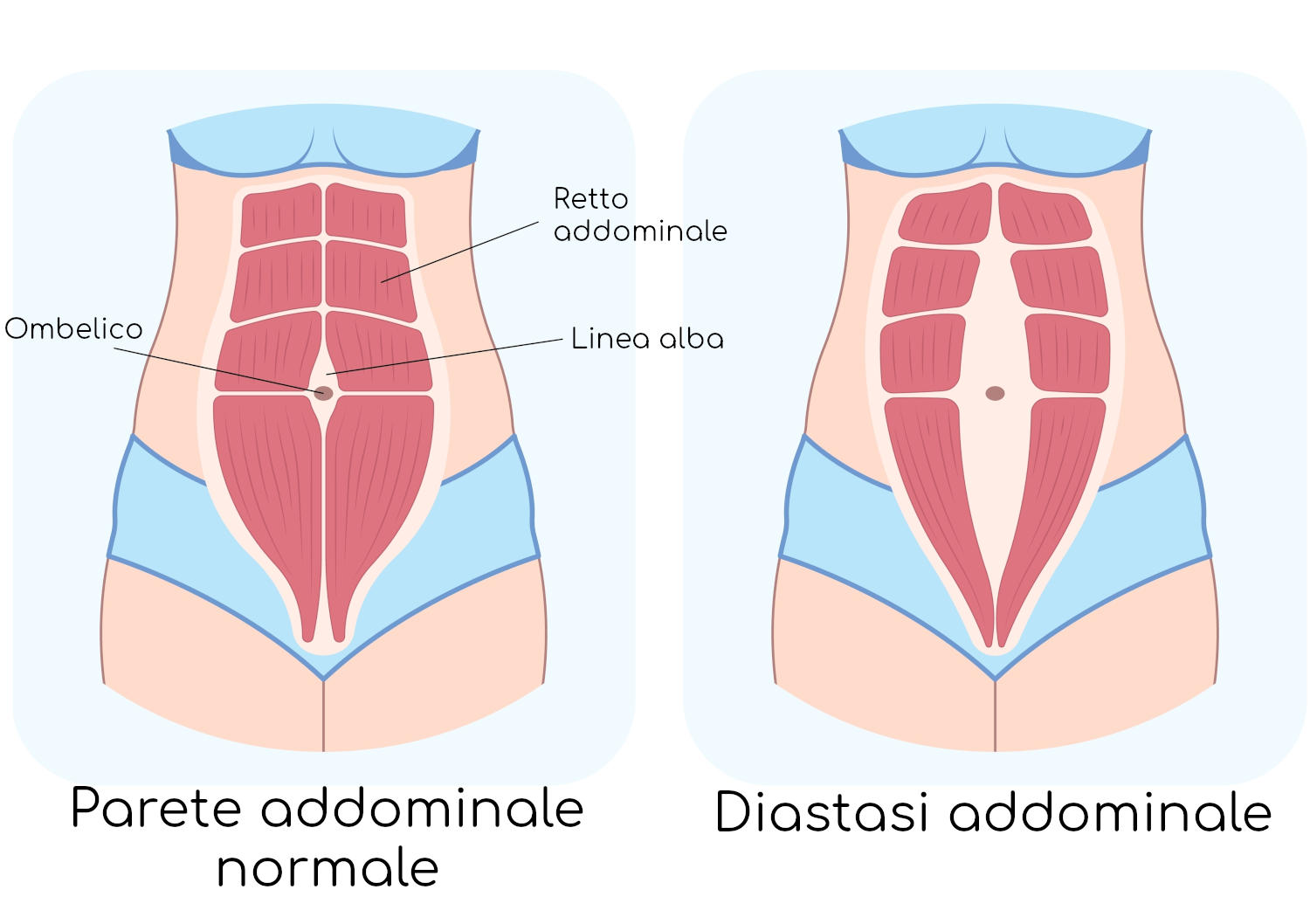 Esemplificazione anatomica della diastasi addominale