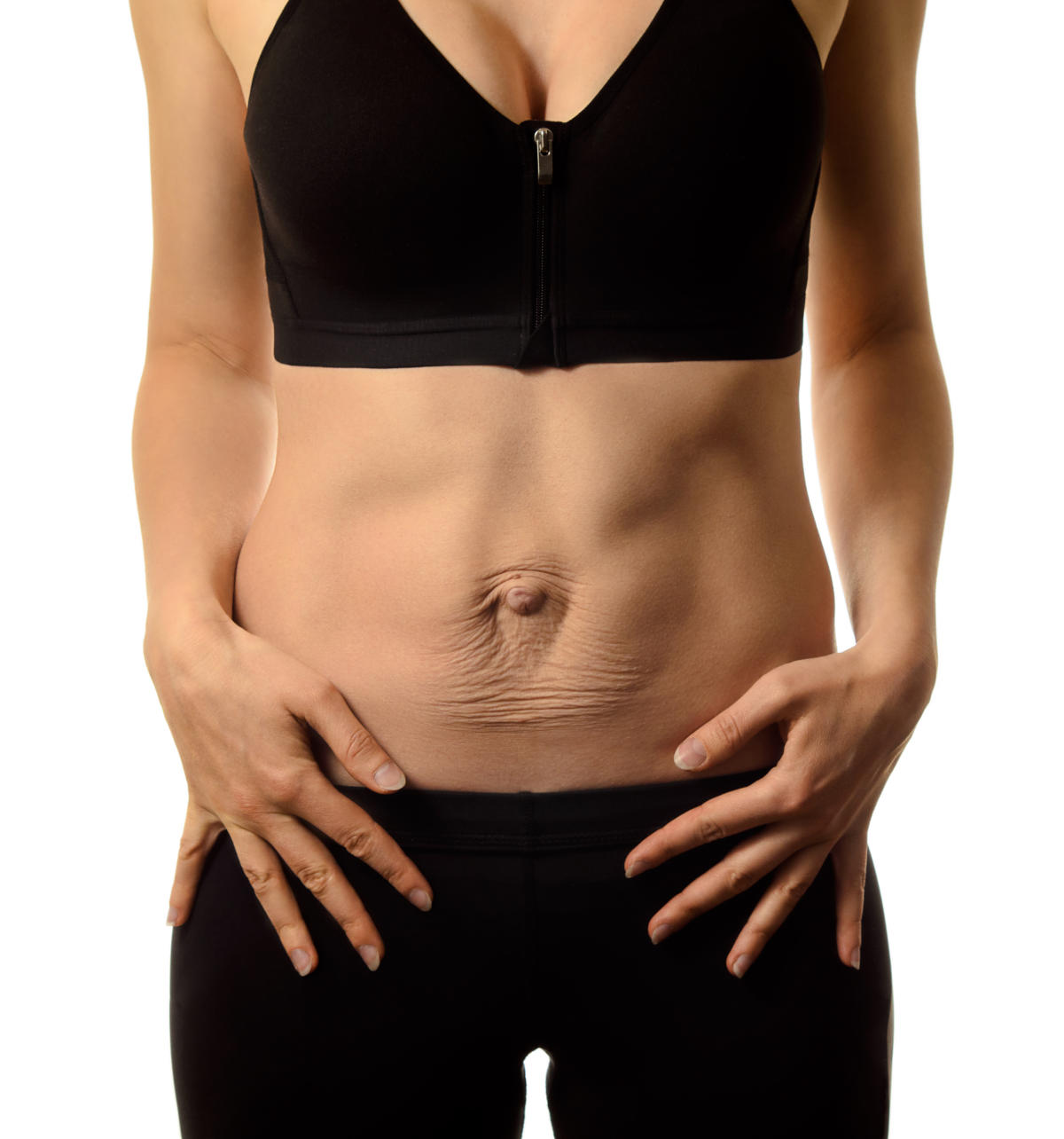 Diastasi addominale in una donna