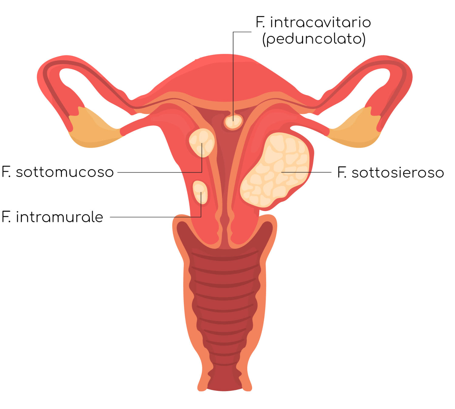 Rappresentazione semplificata delle diverse tipologie di fibroma uterino