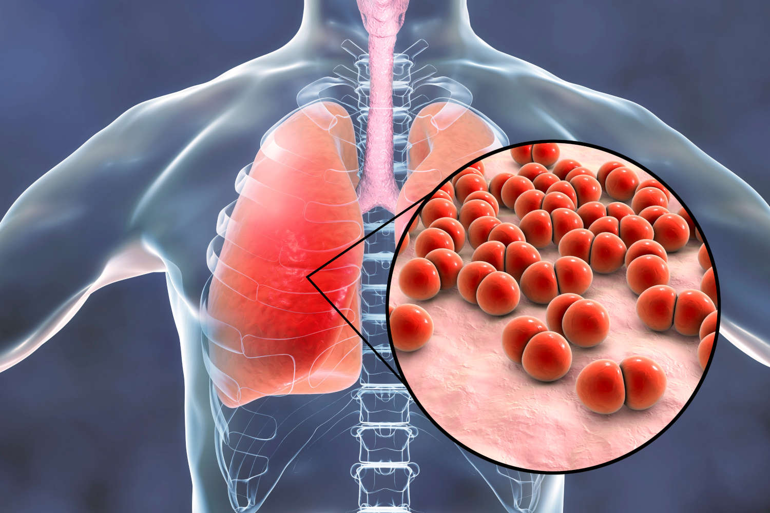Immagine concettuale della polmonite pneuomococcica