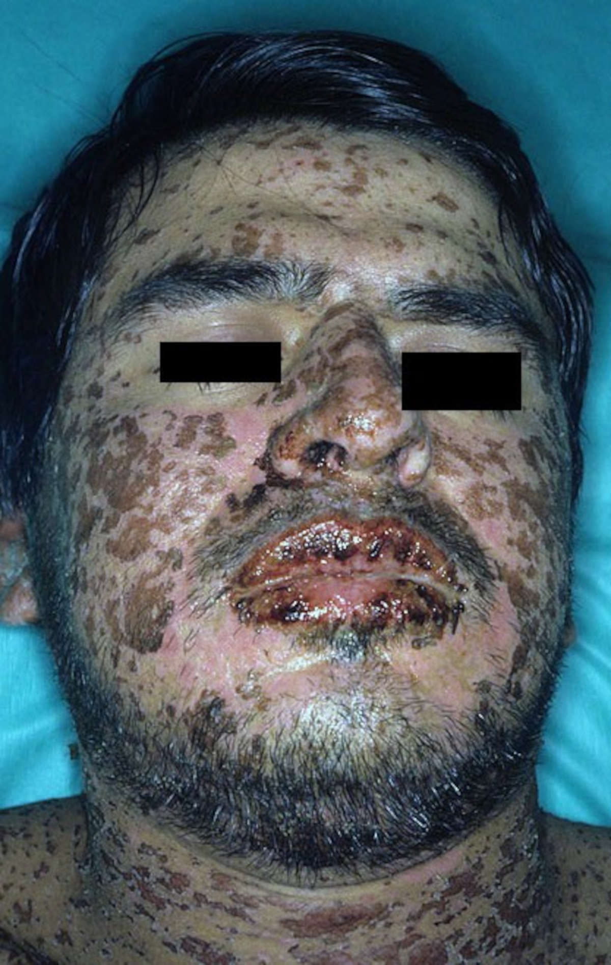 Vesciche sul viso di paziente affetto dalla sindrome di Stevens-Johnson