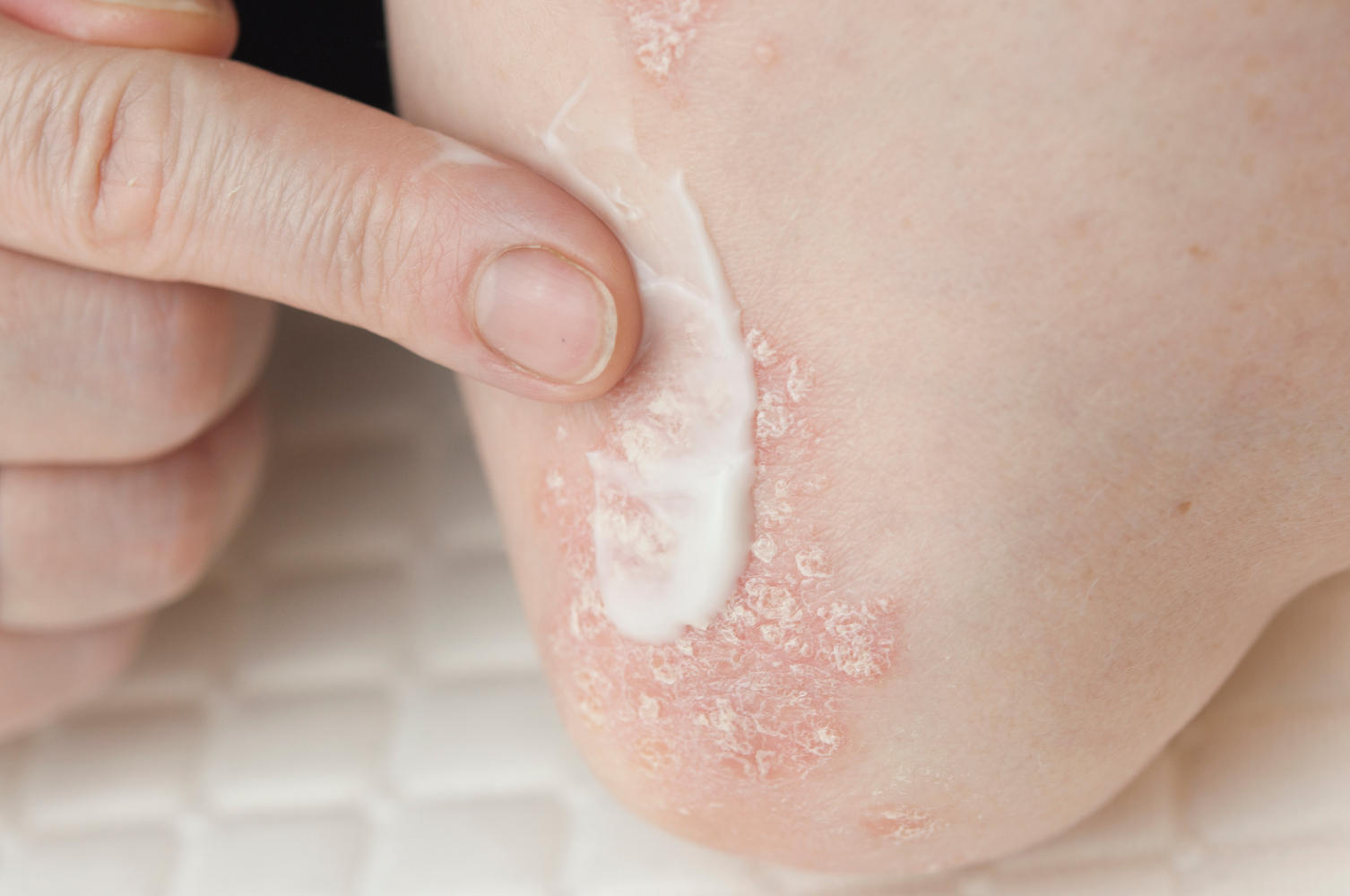 Applicazione di crema sul gomito affetto da psoriasi