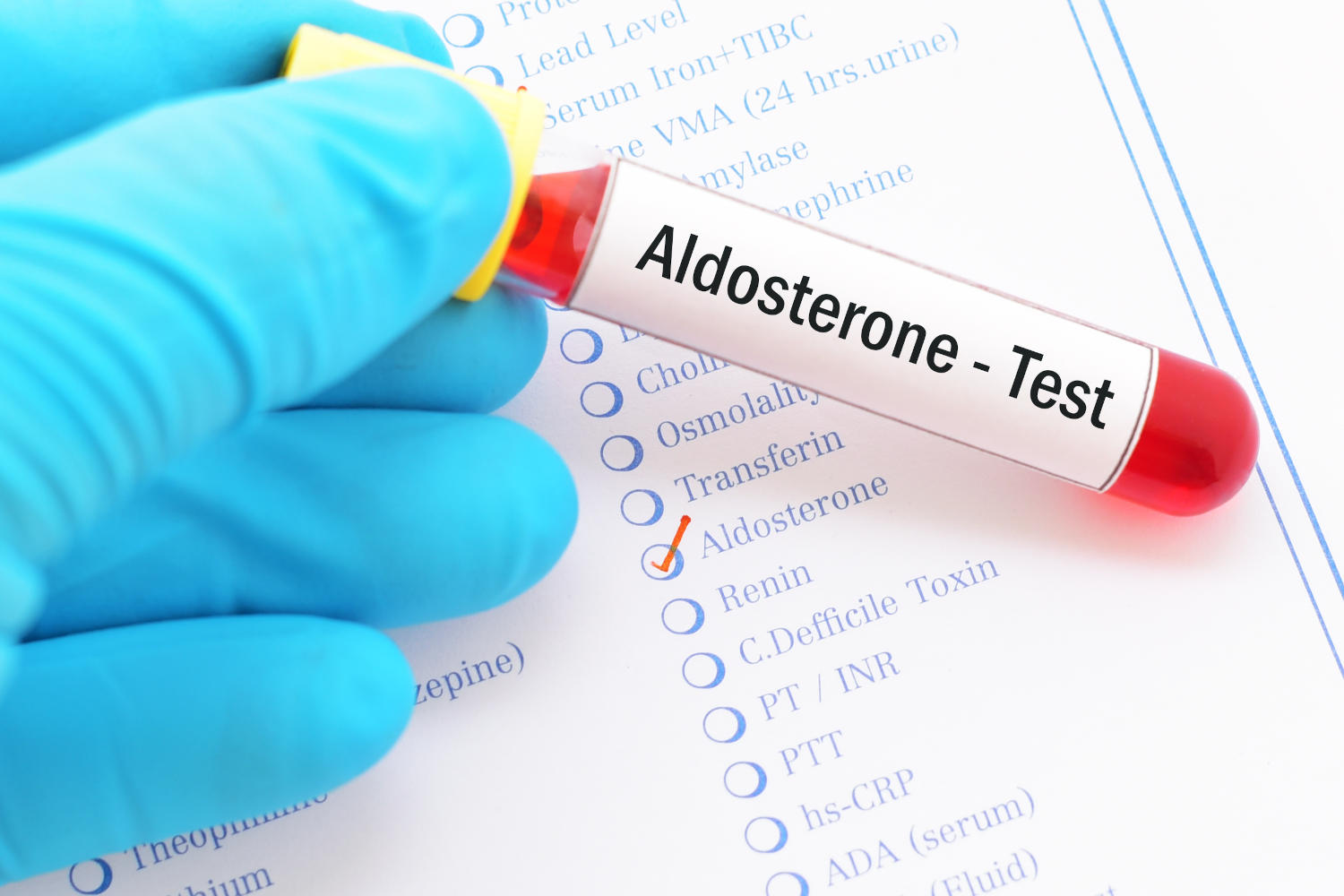 Provetta di sangue con la scritta "Aldosterone"