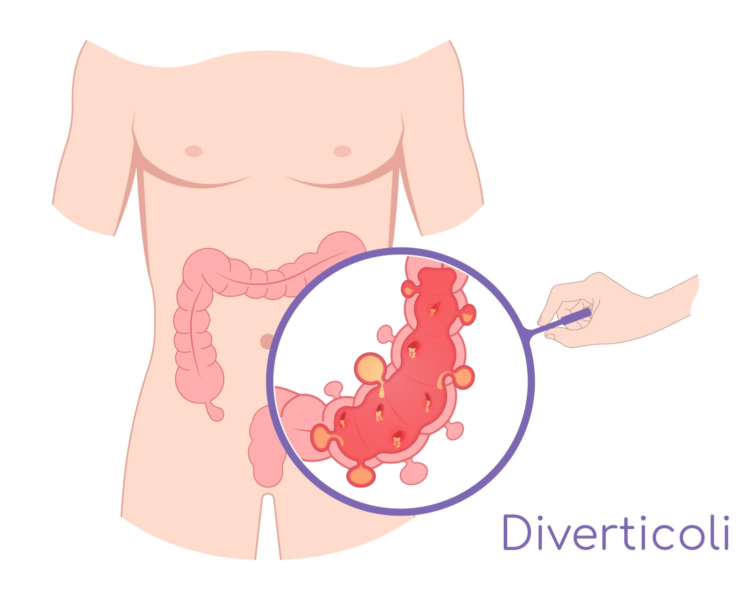 Ricostruzione grafica semplificata dei diverticoli