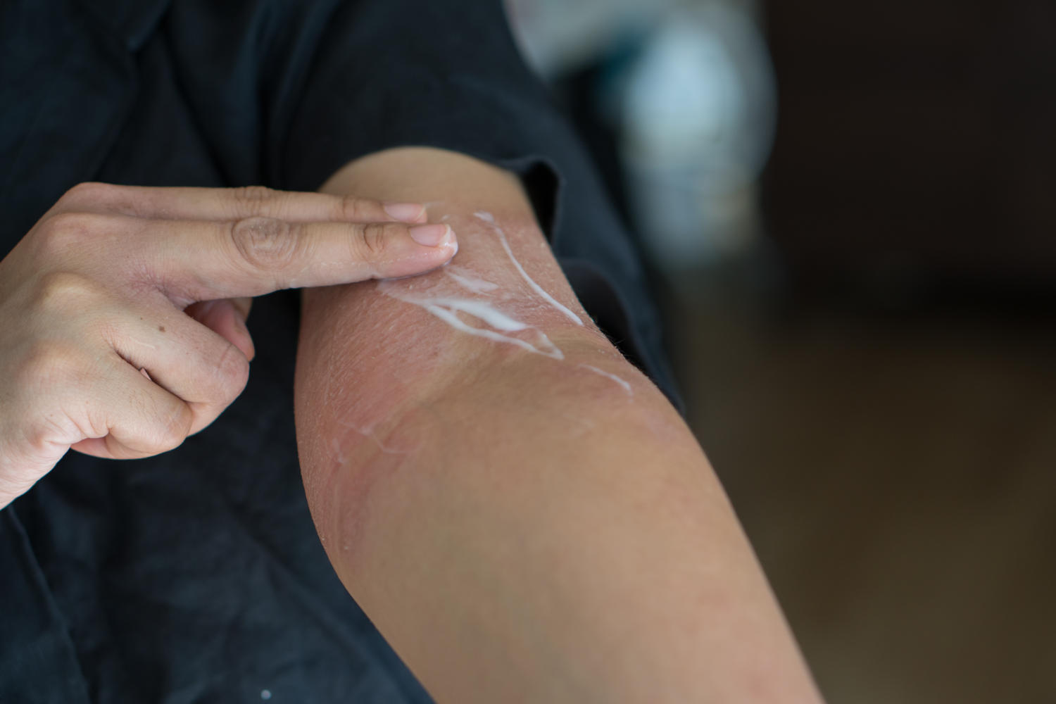 Applicazione di crema sull'interno gomito