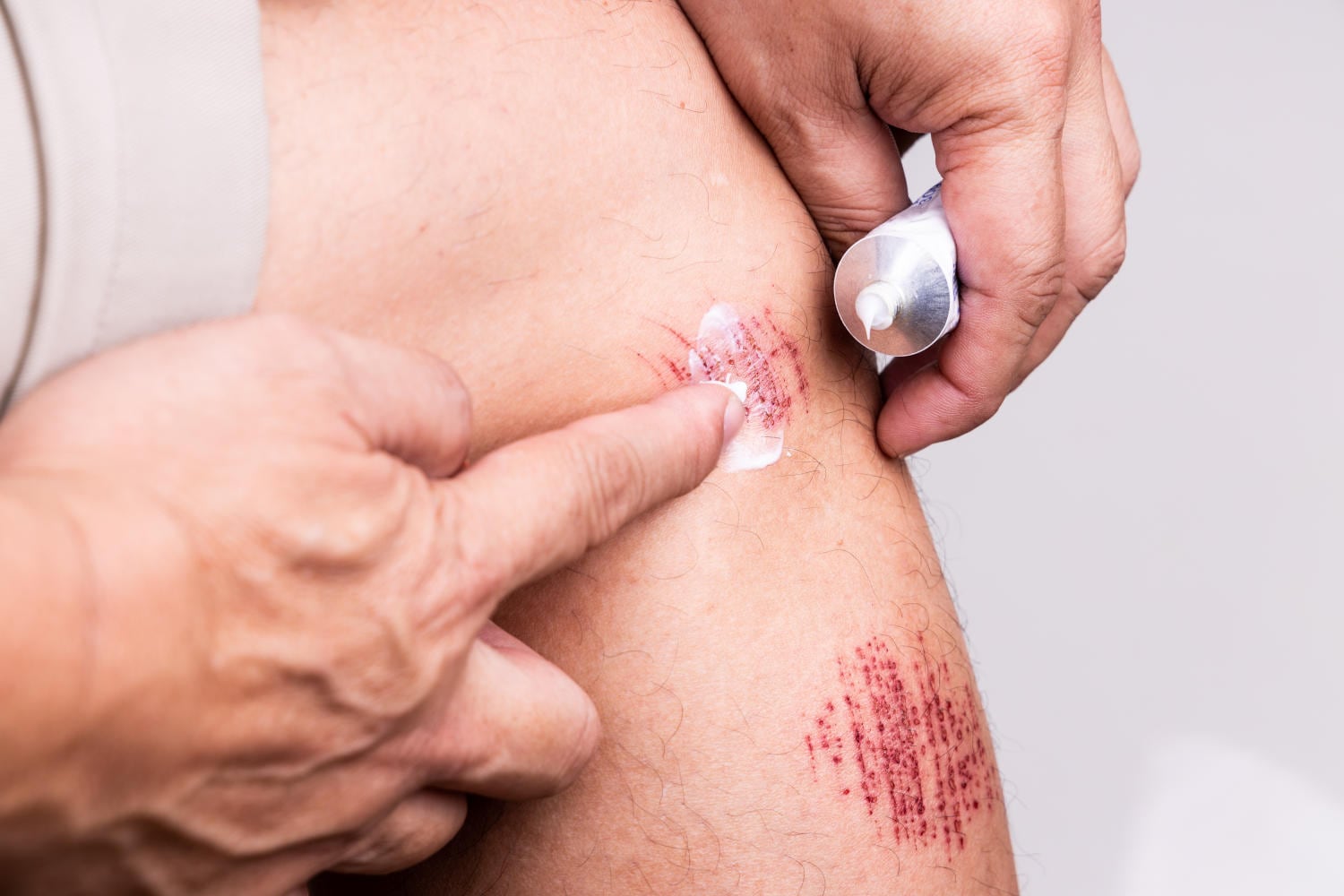 Applicazione di crema su una ferita da abrasione sul braccio