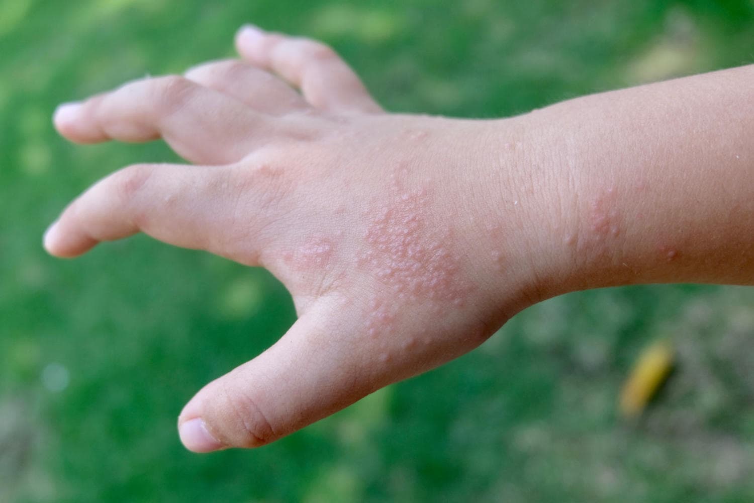 Mano di bambino con evidenti bollicine