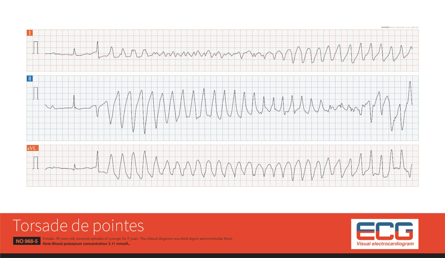 Tracciato elettrocardiografico della torsione di punta