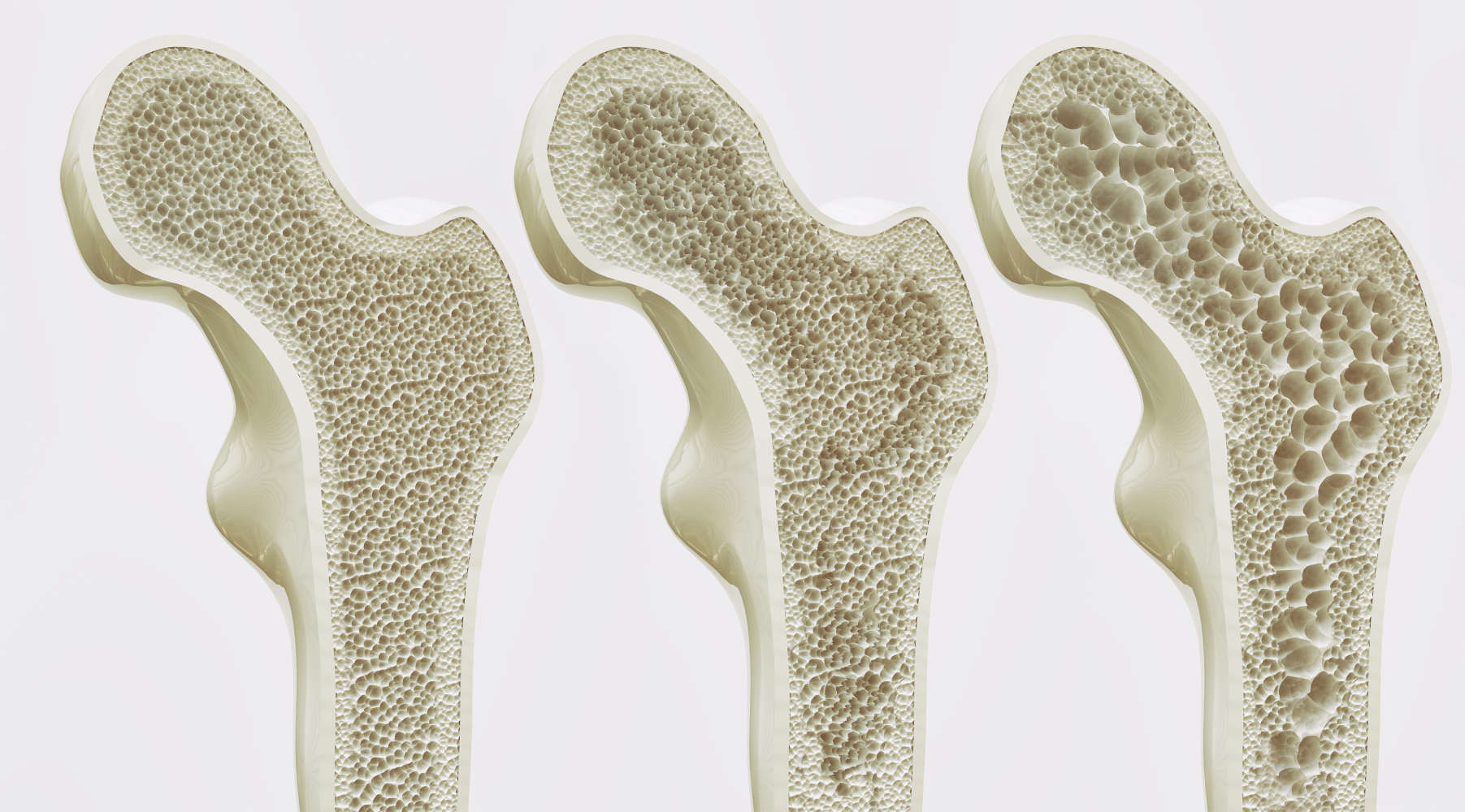 Ossa affette da diversi gradi di osteoporosi