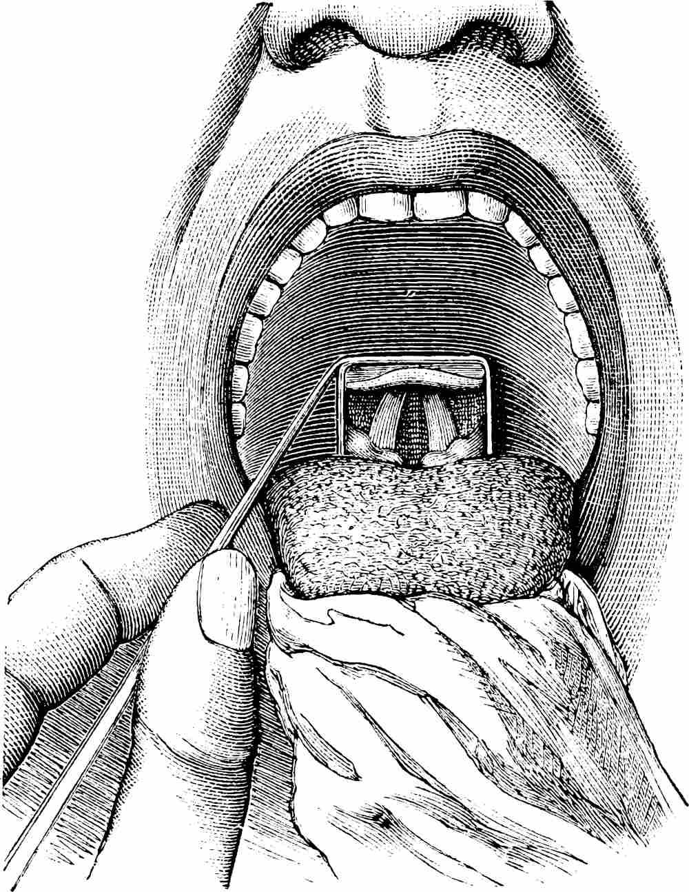 Disegno della laringoscopia indiretta