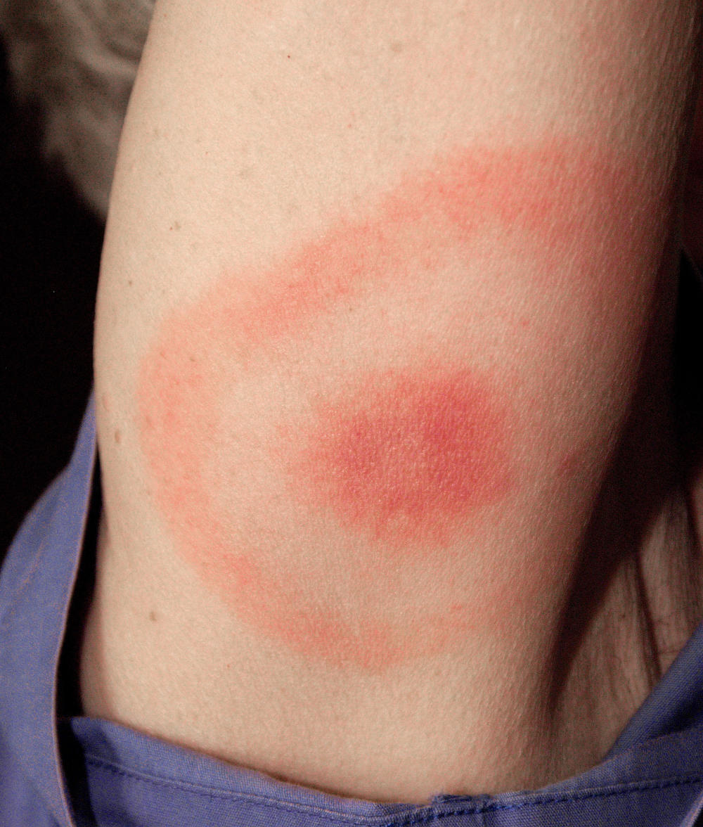 Eritema a bersaglio, caratteristico della malattia di Lyme