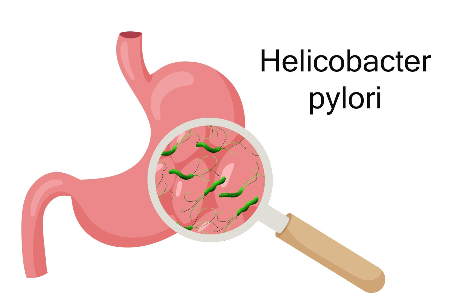 Immagine grafica della presenza di helicobacter nello stomaco