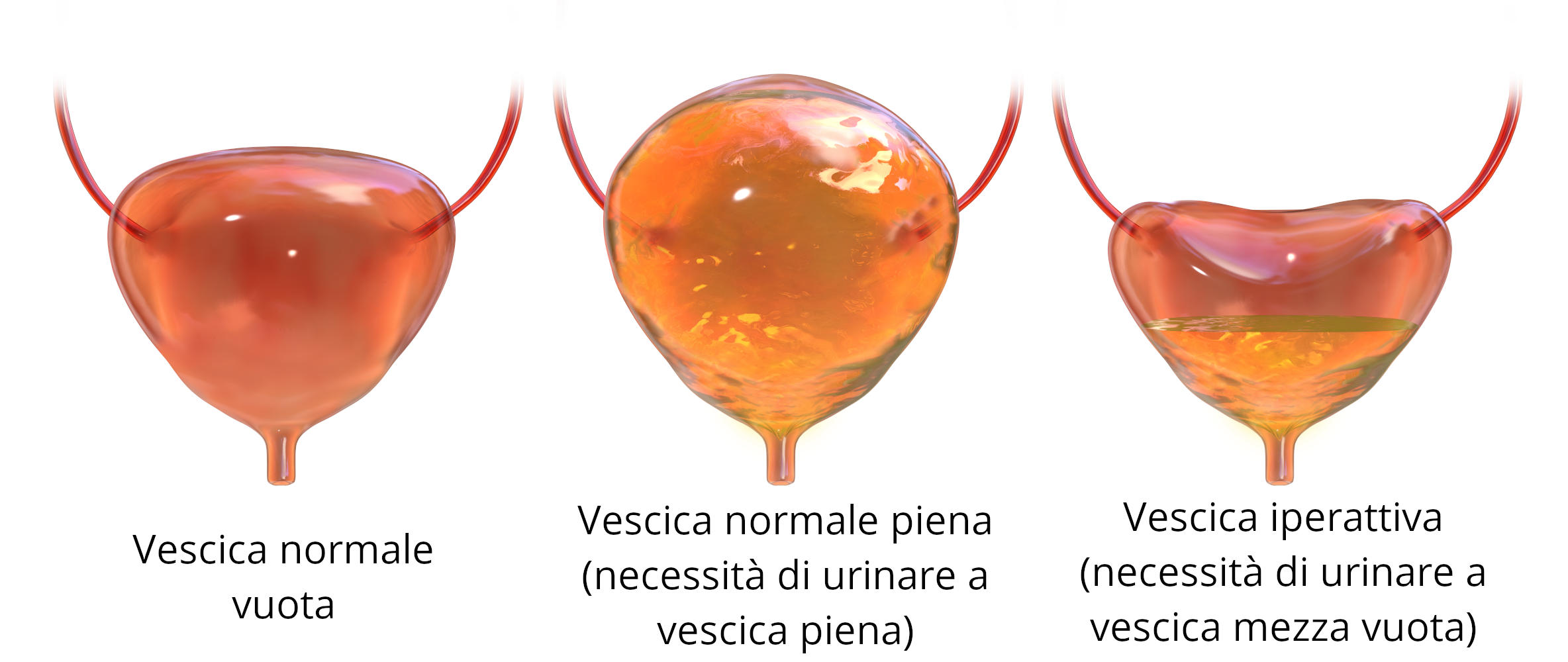 Vescica iperattiva, infografica riassuntiva
