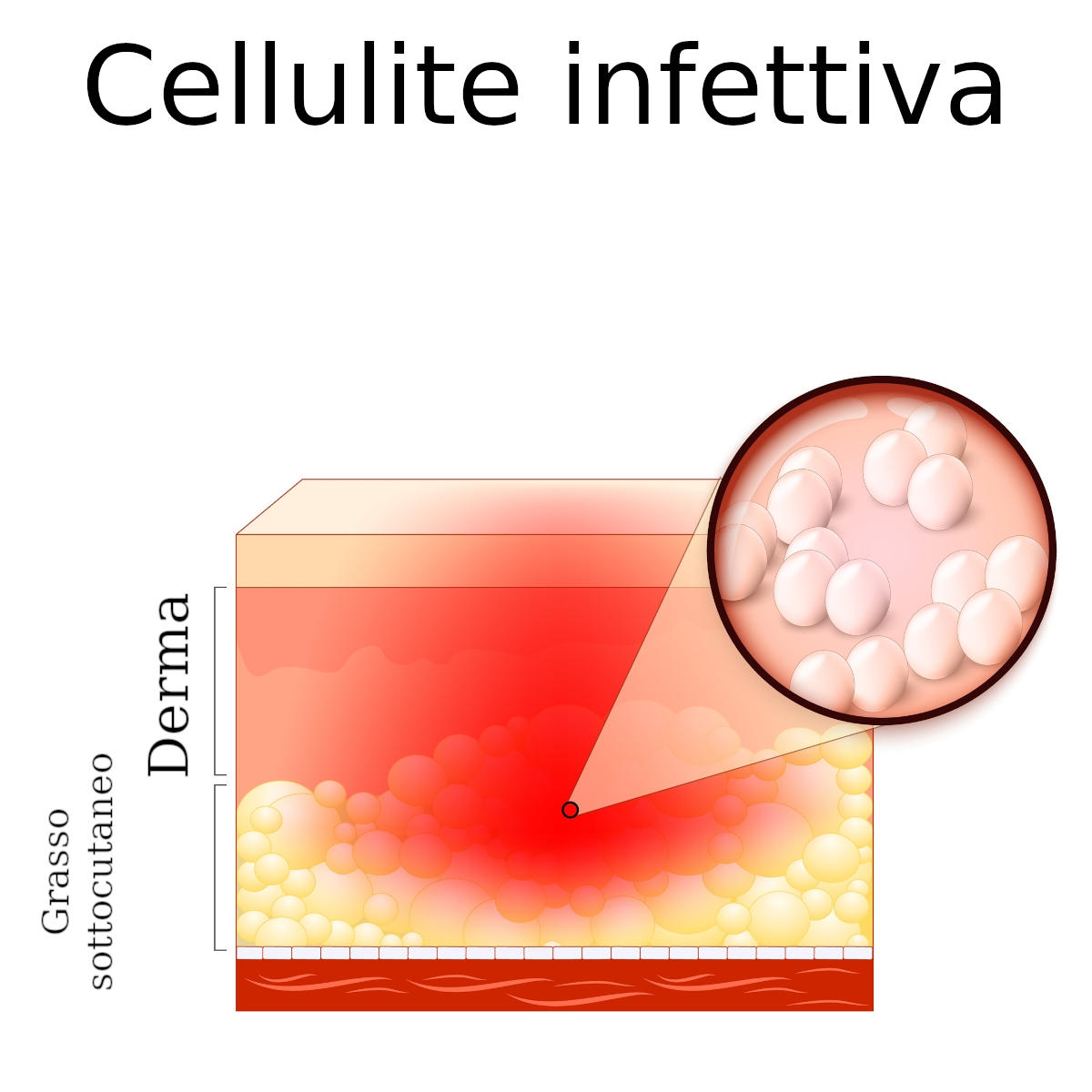 Cellulite infettiva