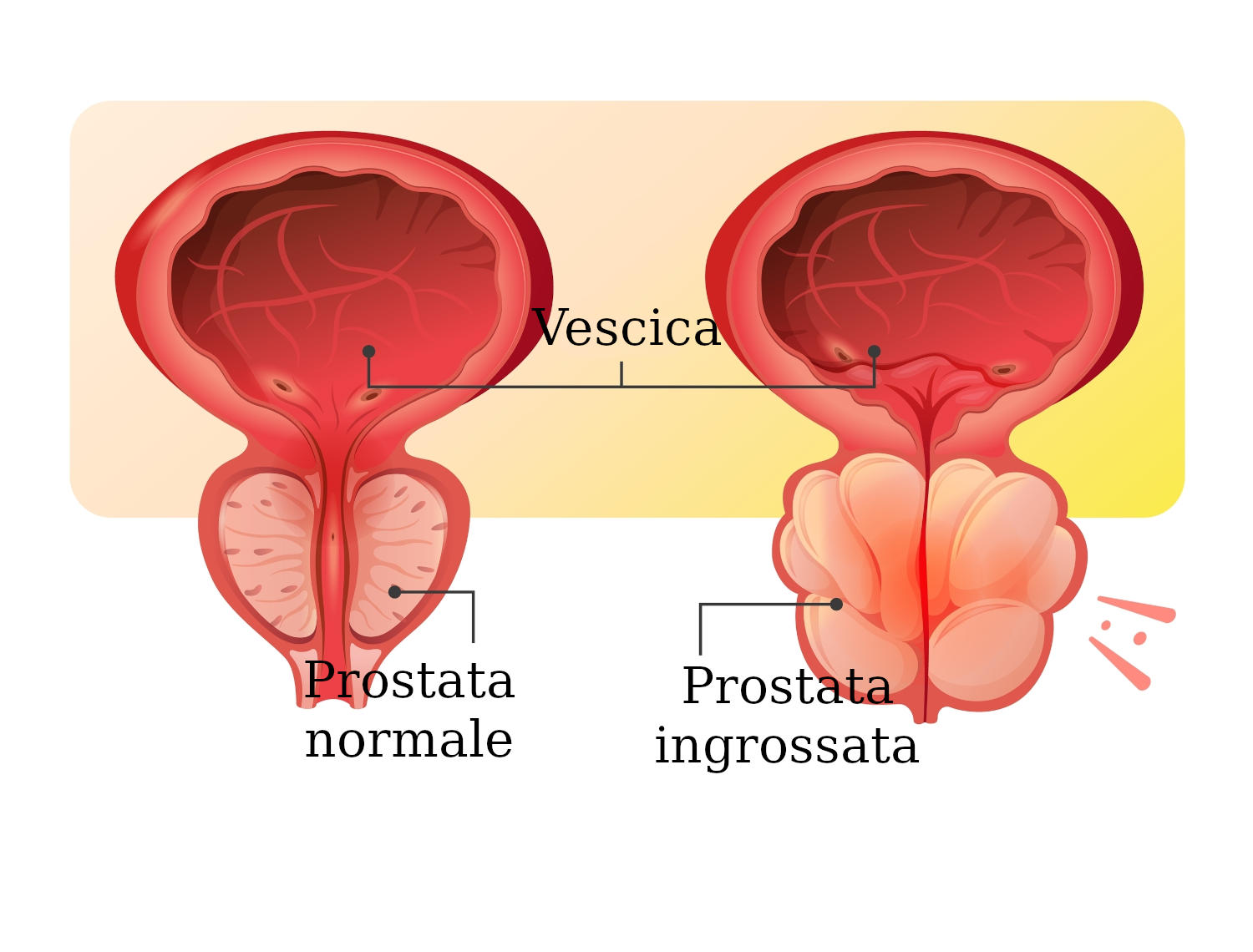 Grafica semplificata che mostra una prostata ingrossata che comprime l'uretra