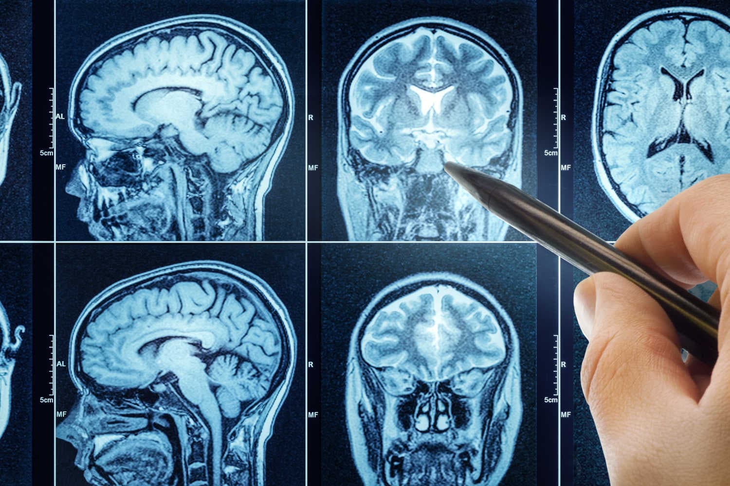 Tumore al cervello in una scansione cerebrale