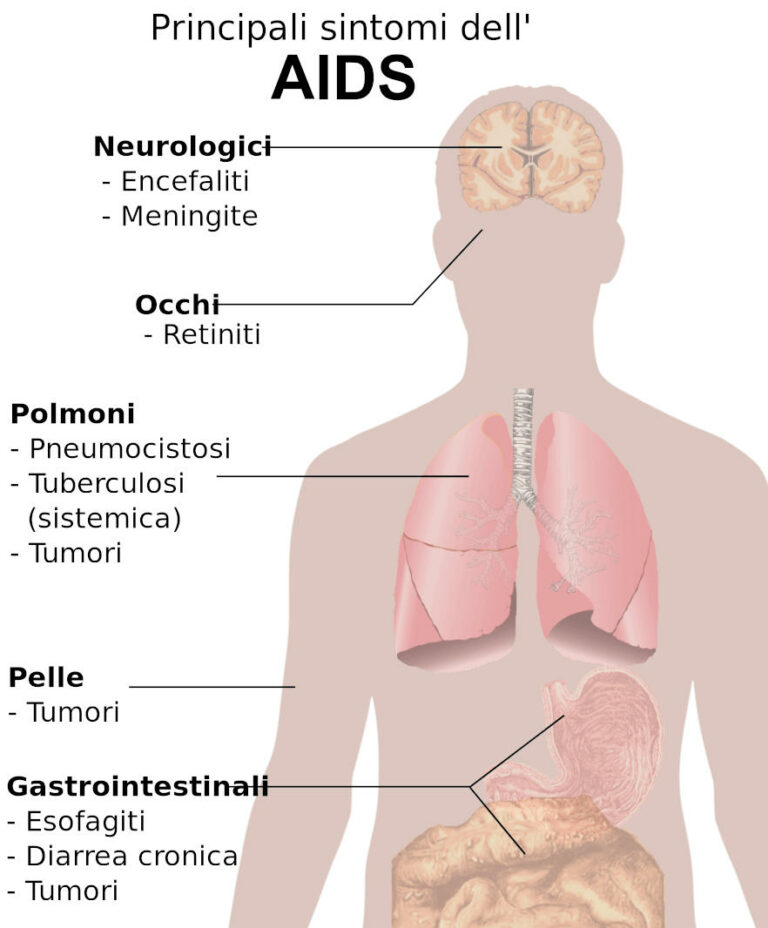 Infografica sintomi AIDS