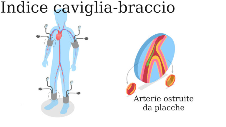 Infografica riassuntiva dell'indice caviglia-braccio