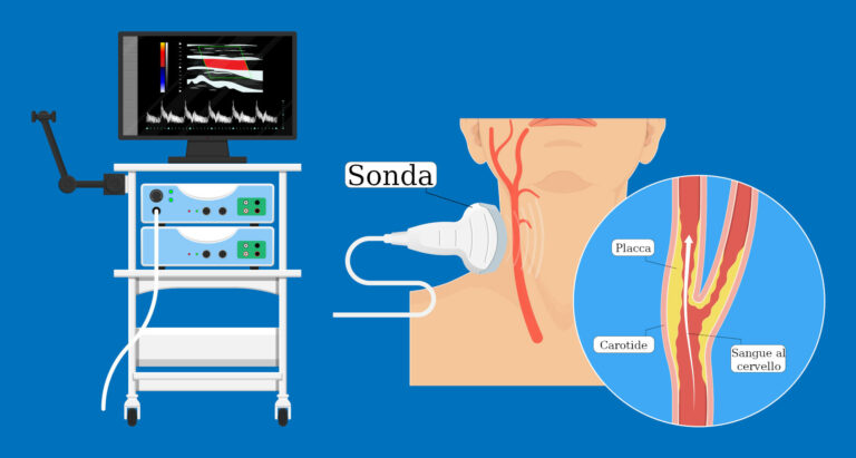 Ecodoppler TSA, riassunto grafico