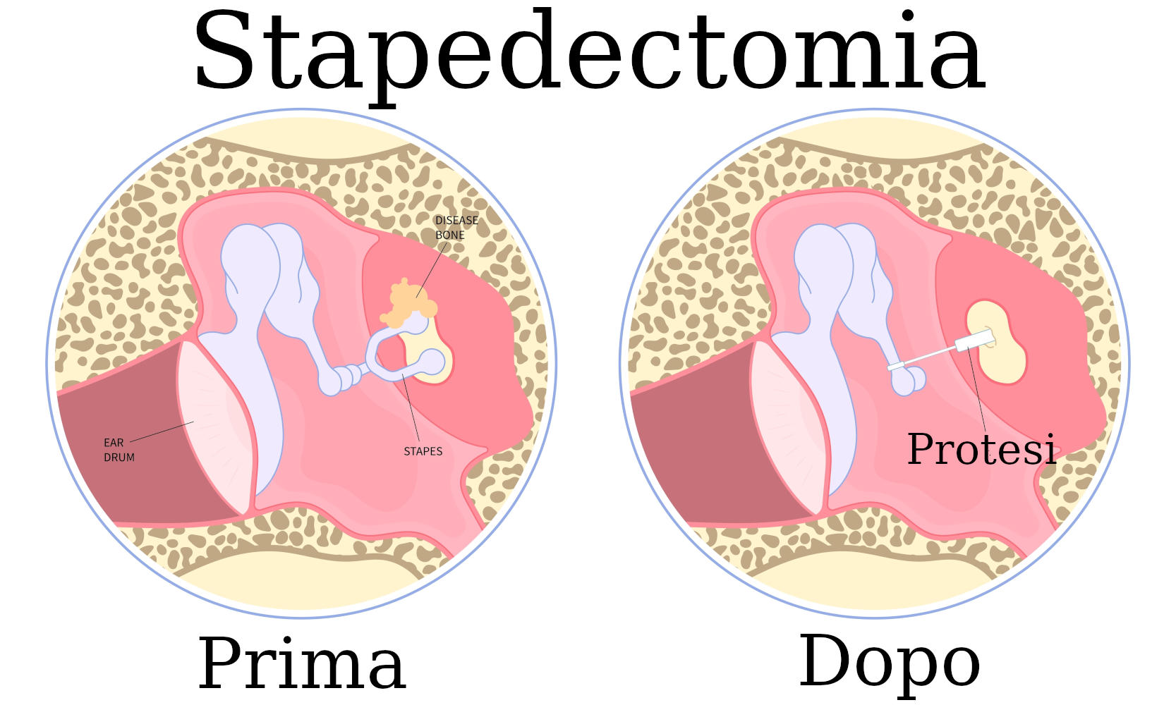 Esemplificazione stapedectomia