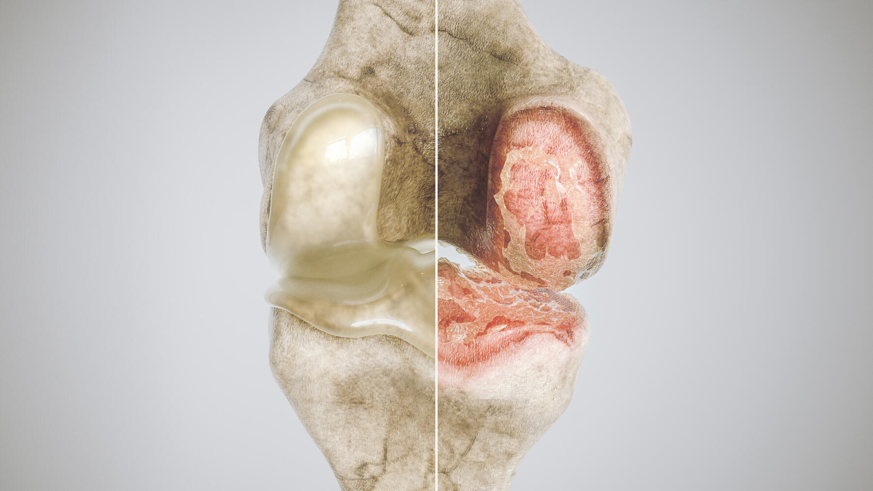 Esemplificazione grafica del processo di osteoporosi