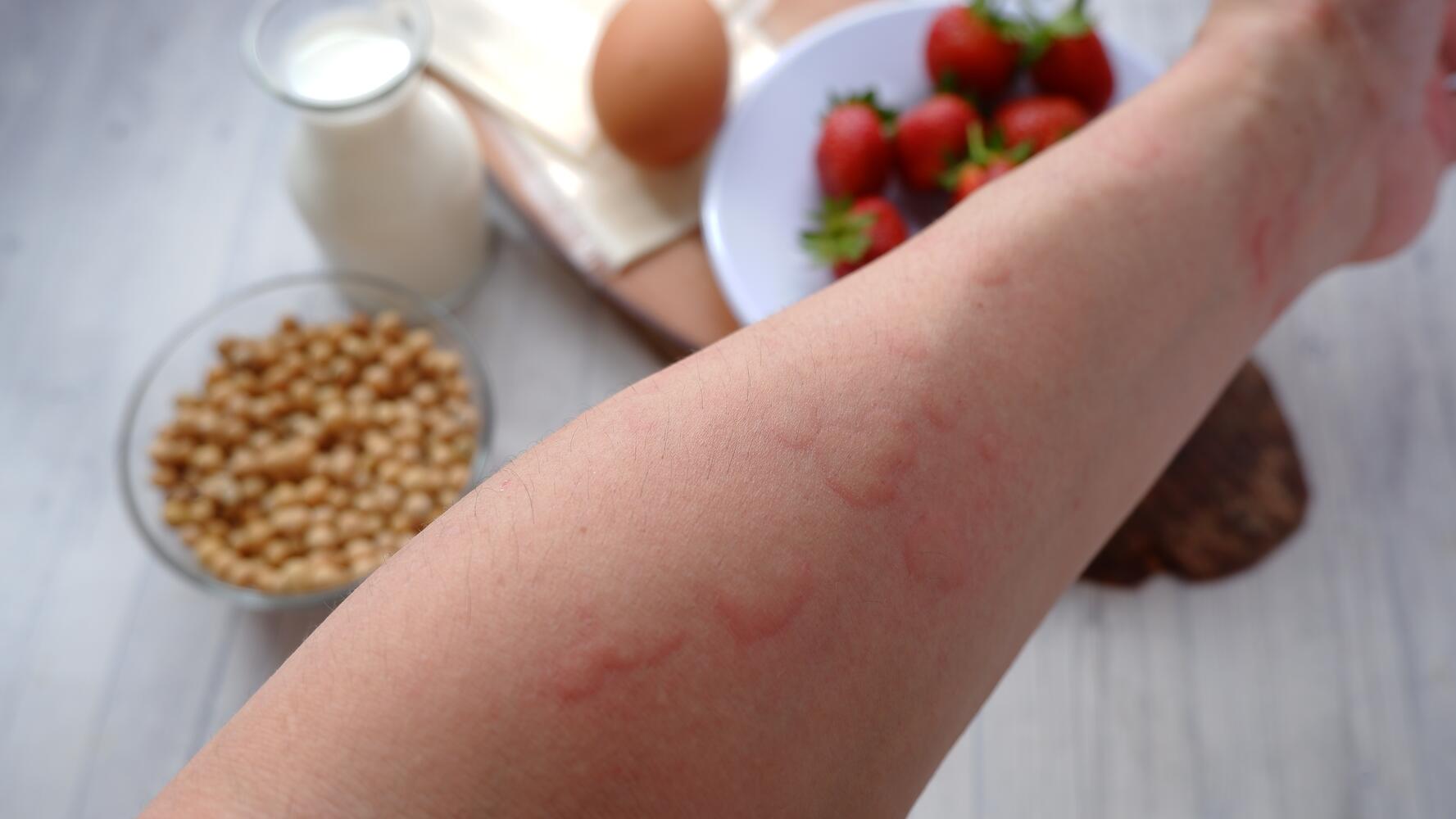Urticaria su un braccio