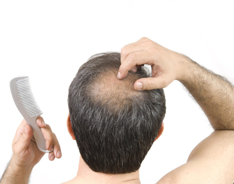 Alopecia Androgenetica Femminile E Maschile Cause E Cura
