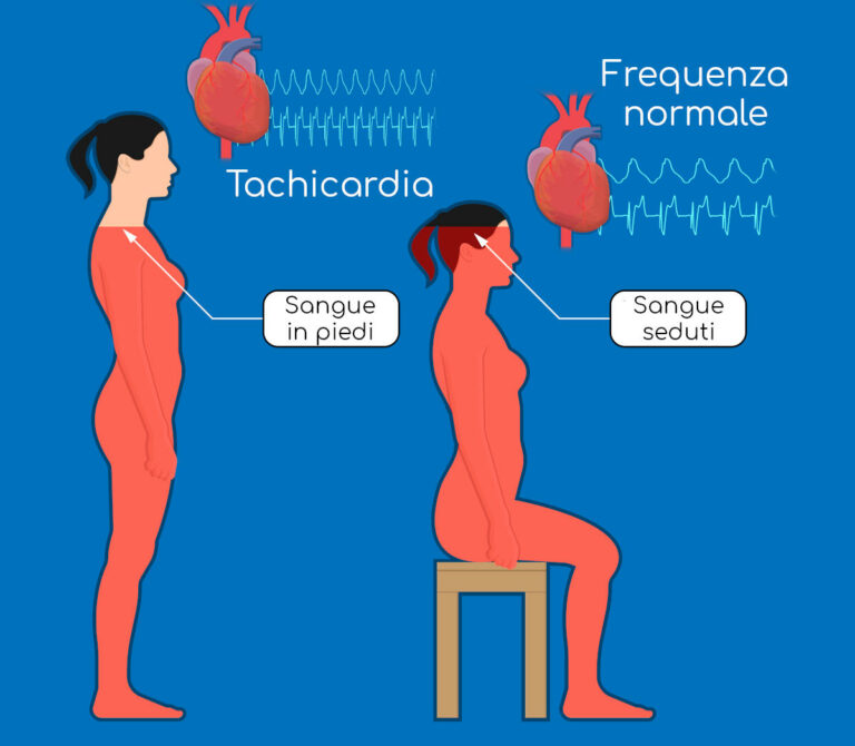 Tachicardia Posturale Ortostatica POTS Cause Sintomi Pericoli E Cura